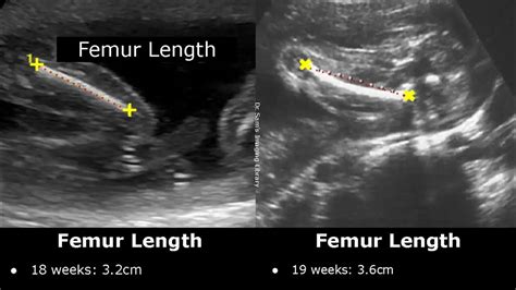 crown of femurs|small femur length in fetus.